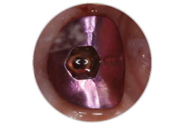 tissue_former_milledtitanium Milled titanium