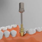 Implant prosthetics