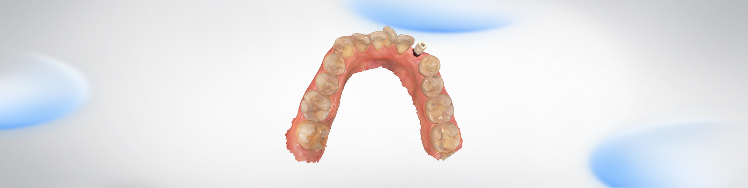 Single Unit Implant