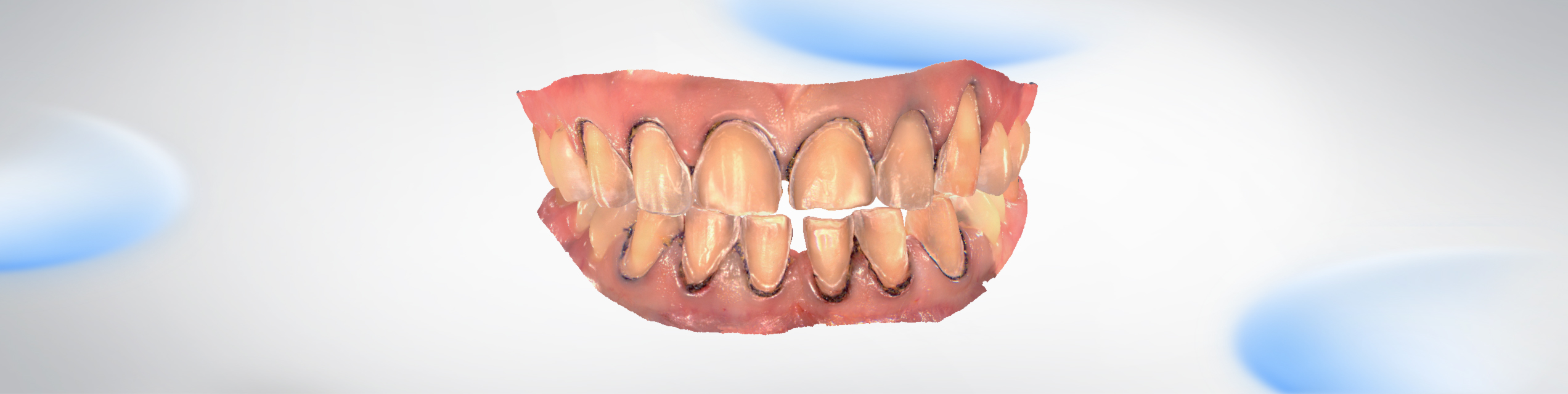 Veneer