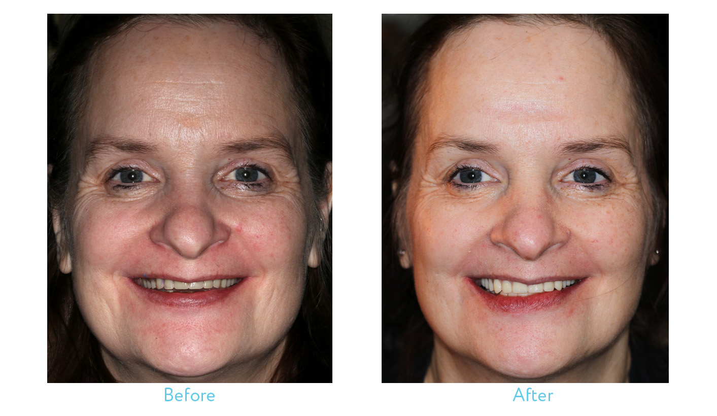 Denture Process Lori Patient for web