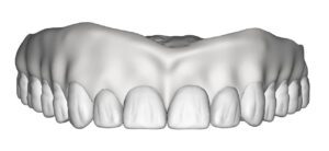 Upper MonoBlock try-in_Lori