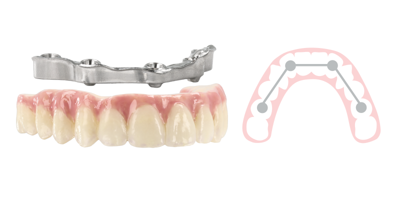 Composite Hybrid with bar