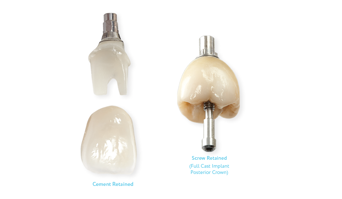 Implant Crowns