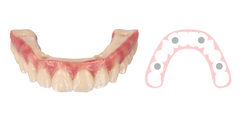 Zirconia Hybrid